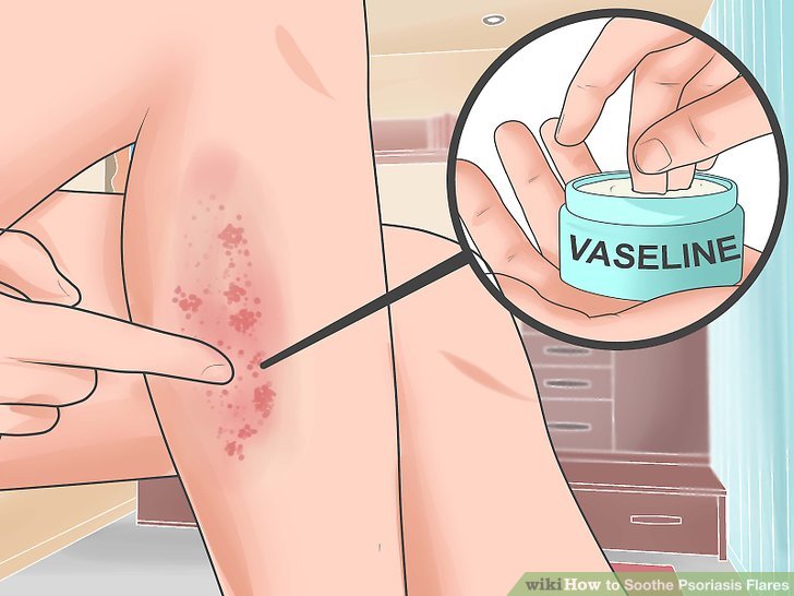 Psoriasis bisa ditangani dengan obat oles (Sumber: wikihow.com)