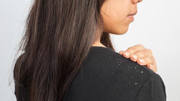 Ilustrasi ketombe (Sumber: yurielkaim)