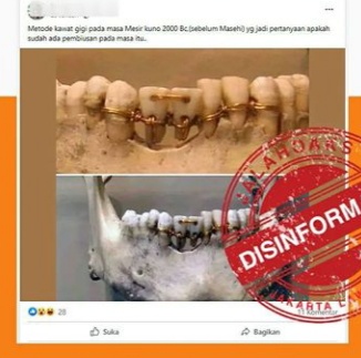 [HOAKS atau FAKTA] Gigi Kawat Sudah Ada Masa Mesir Kuno