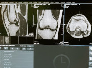 Perempuan Rawan Osteoporosis, Kok Bisa?