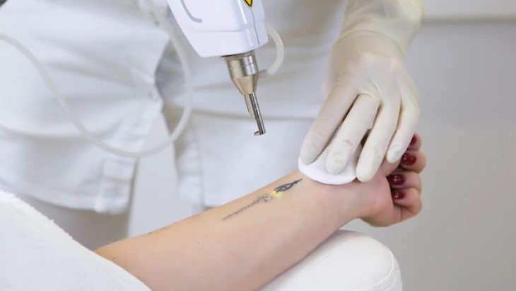 Cara Merawat Kulit setelah Hapus Tato dengan Laser