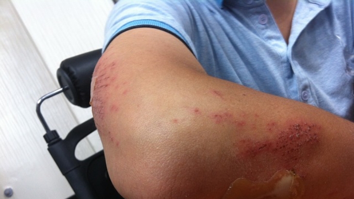 Sering Disepelekan, Waspada Hematoma Si Silent Killer