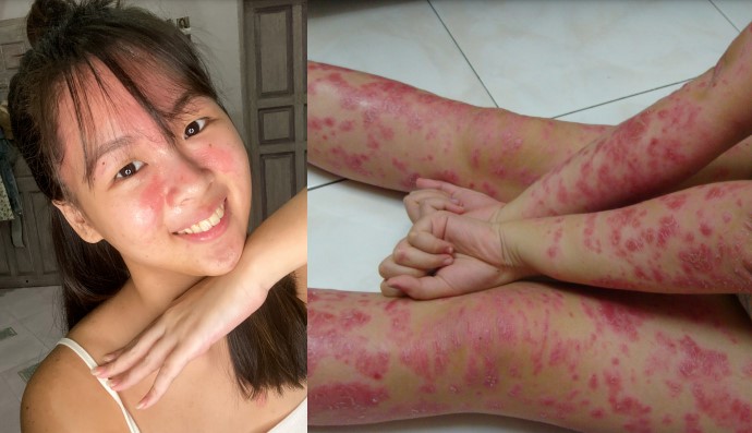 psoriasis