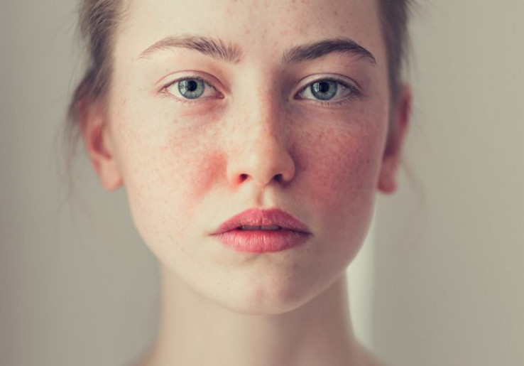 5 Faktor Penyebab Penyakit Rosacea Menurut Ahli Dermatologi