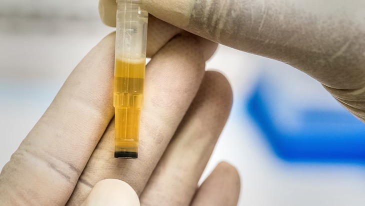 Perhatikan Jumlah dan Warna Urine untuk Kandung Kemih Sehat
