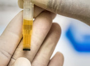 Perhatikan Jumlah dan Warna Urine untuk Kandung Kemih Sehat