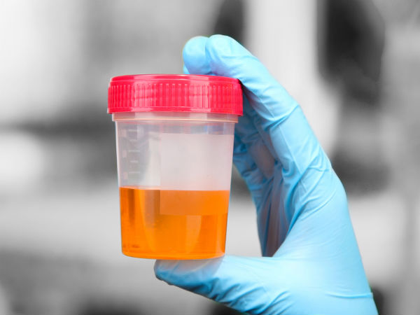 Penggumpalan urine (Foto: Boldsky)