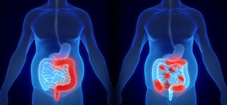 Bagaimana Personalised Medicine dalam Kanker Kolorektal?