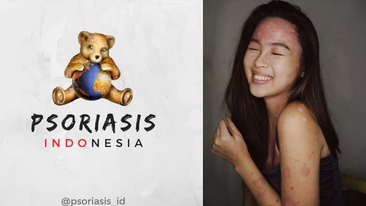 Pemuda Penyintas Autoimun Negeri Aing Hapus Stigma Negatif Psoriasis Lewat Kampanye Se-Asia Tenggara