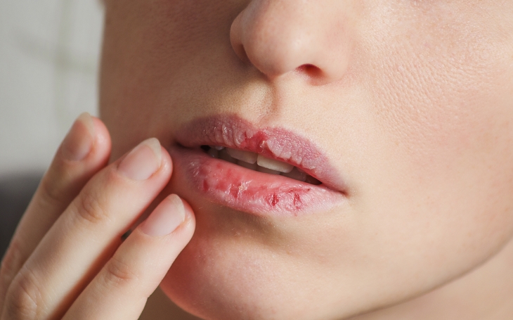 Bibir kering dan iritasi dapat disebabkan pemakaian lip balm terlalu sering. (Foto: saudijobvacancy.com)