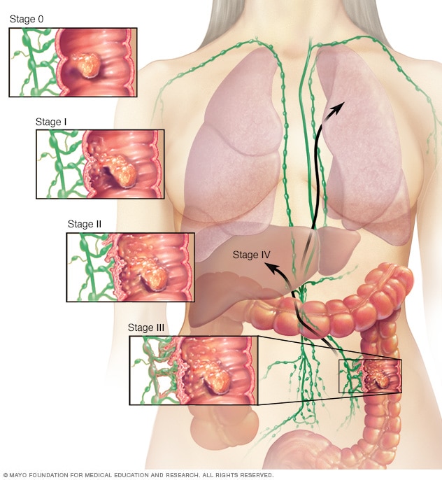 Usia dan berat badan mempengaruhi risiko kanker usus (Sumber: Mayo Clinic)