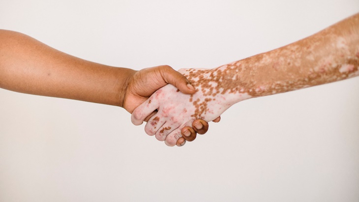 autoimun kulit vitiligo
