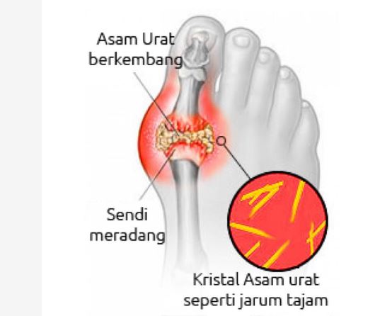[HOAKS atau FAKTA]: Cara Ketahui Asam Urat dengan Jari Ditekuk sampai Telapak Tangan