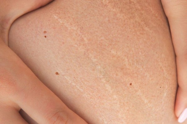Jeruk bali bisa memudarkan selulit (Foto: healthline.com)