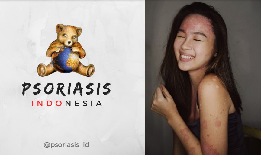 Penyintas Autoimun Negeri Aing Gemakan Kampanye Se-Asia Tenggara Hapus Stigma Negatif Psoriasis