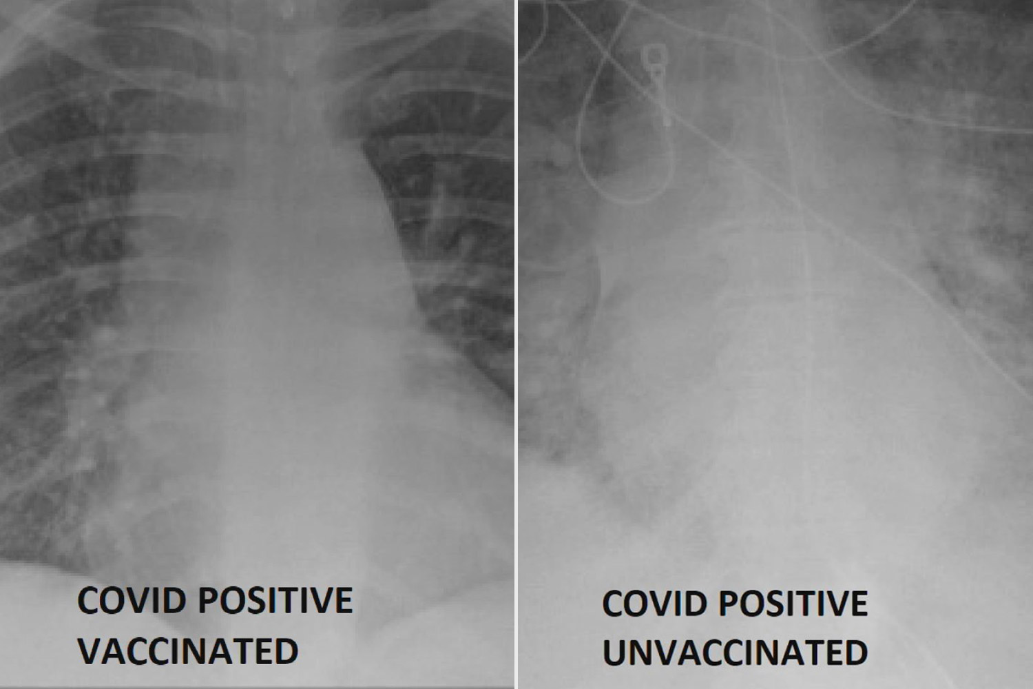 (Kiri) hasil X-ray pasien COVID-19 yang sudah vaksin, (kanan) hasil x-ray vaksin yang belum vaksin. (Foto SSM Health)
