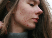 Apakah 'Dermatitis' Bisa Menyerang Anak-Anak? Begini Penjelasannya