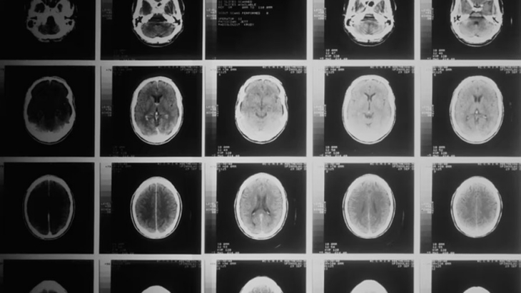 Teknik MRI Baru Bantu Deteksi Multiple Sclerosis Lebih Cepat