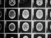 Teknik MRI Baru Bantu Deteksi Multiple Sclerosis Lebih Cepat