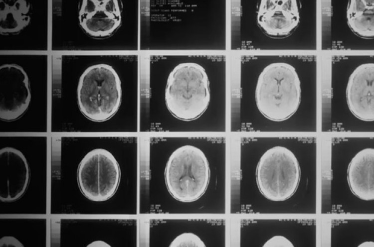 Teknik MRI Baru Bantu Deteksi Multiple Sclerosis Lebih Cepat