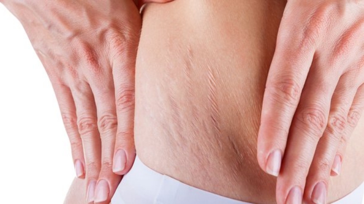 Ingin Stretch Mark Hilang? Begini Caranya
