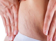 Ingin Stretch Mark Hilang? Begini Caranya