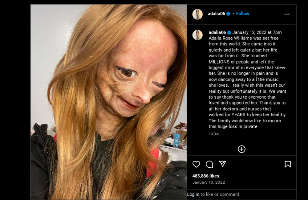 Adalia Rose penyintas Progeria