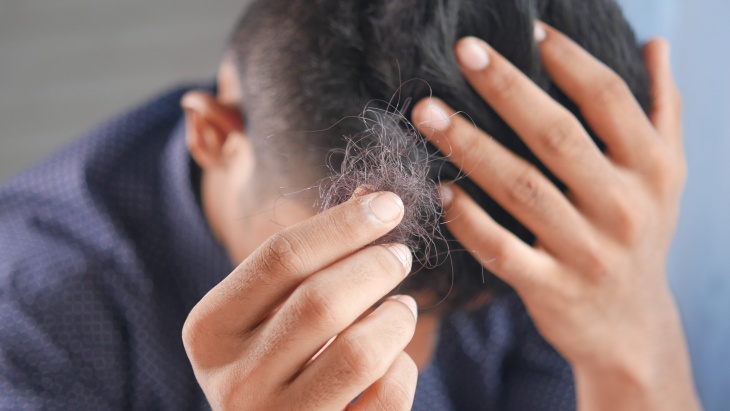 Perhatikan 3 Hal ini Sebelum Melakukan Transplantasi Rambut