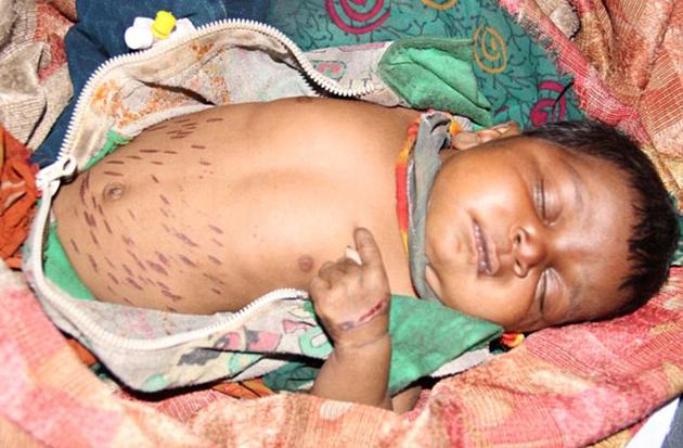 Percaya Pada Dukun, Seorang Bayi Harus Dirajam Besi Panas Hingga 40 Kali